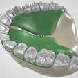 Removable-Palatal-Expansion-Appliance,-molar-distalizer,-teeth,-dental,-tooth,-palatal-expander,-app.png Aparato de Expansión Palatal Removible (KDE) en Dientes Superiores Aparato Dental