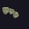 upper-bridge.png Dental Crown Bridge Anterior