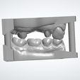 Clipboard-2024-06-11-14-40-03.jpg 10 DENTAL STUDY MODELS - REAL PATIENTS, UPPER AND LOWER 3D MODELS WITH ADDITIONAL DIES