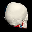 i3.jpg 3D Model of Brain Arteriovenous Malformation