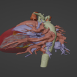 10.png 3D Model of Human Heart with Ventricular Septal Defect (VSD)