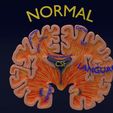ps21.jpg Alzheimer Disease Brain coronal slice