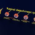 retinal-detachment-types-eye-3d-model-blend-62.jpg Retinal detachment types eye 3D model