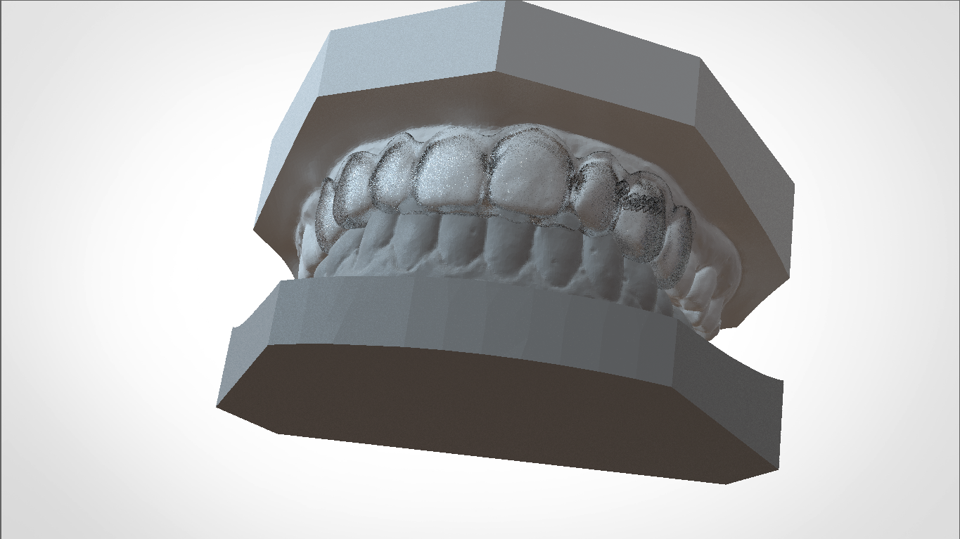 Download OBJ file Digital Ortho Mini Deprogrammer Splint • 3D printing ...