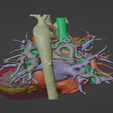 4.png Model of human heart with pulmonary atresia (PuA) - generated from real patient