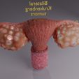 image-0019.jpg Krukenberg ovarian cancer tumor