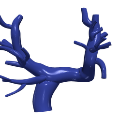 chd1.png.5368260a2188e7a85c688980d16bca8e.png 3D Model of Pulmonary Arteries (Fontan Procedure)