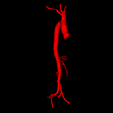 7.png 3D Model of Aorta and Aortic Vessel Tree - generated from real patient