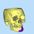 5.png MANDIBLE IMPLANT