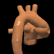 24.png 3D Model of Transposition of the Great Arteries Open Duct
