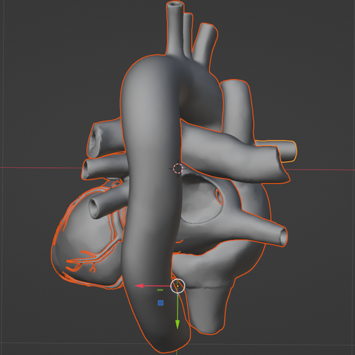 30.png 3D Model of Partial Anomalous Pulmonary Venous Connection