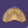 eee) predeterminada exocad SUPERIOR MAXILLARY from Intraoral Scan - AREA3D- Patient A. TOP DENTURE