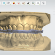 Screenshot_19.png Digital Full Coverage Occlusal Splint with Canine Guidance