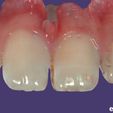 Mostrar Todo v Mostrar/Ocultar totir lg Color/Textura ‘ 4 @) PN o PN Te ye E Tmrt-) Vista lett L- os exocad ..-...:: SUPERIOR MAXILLARY from Intraoral Scan - AREA3D- Patient A. TOP DENTURE