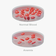 Blood_thumbnail.png Normal Blood Cells vs Anemia