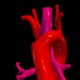 8.png 3D Model of Double Aortic Arch