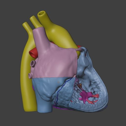 03.jpg 法洛氏四联症心脏 3D 模型