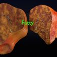 ps8.jpg 3D Alchoholic liver disease cirrhosis hepatitis fatty model