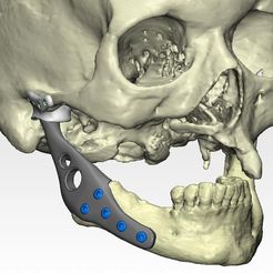 4-implant.jpeg Individual prosthesis for jaw reconstruction (example of a real operation)