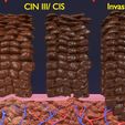 ps8.jpg Cervical cancer dysplasia CIN 3D model