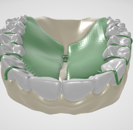 Removable-Palatal-Expansion-Appliance,-molar-distalizer,-teeth,-dental,-tooth,-palatal-expander,-app.png Aparato de Expansión Palatal Removible (KDE) en Dientes Superiores Aparato Dental