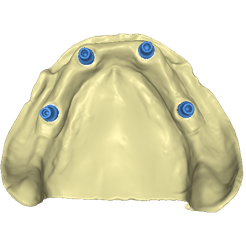 modelPreview.png STL file STL model with implants for All on 4・3D printing model to download