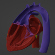 7.png 3D Model of Heart with Transposition of the Great Arteries, long axis view
