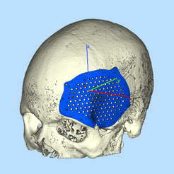 Capture1.png SKULL WITH CRANIAL FLAP