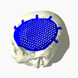 Capture2.png CRANIAL IMPLANT WITH DEFECT