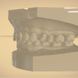 Screenshot_15.png Digital Orthodontic Study Models with Virtual Bases