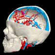 i14.jpg 3D Model of Brain Arteriovenous Malformation
