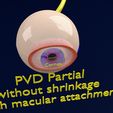 posterior-vitreous-detachment-types-eye-3d-model-blend-64.jpg Posterior vitreous detachment types eye 3D model