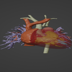 1.png 3D Model of Human Heart with Aortic Arch Hypoplasia (AAH) - generated from real patient