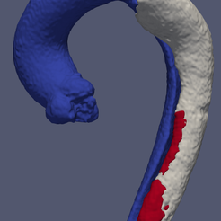 1.png Modèle 3D de dissection aortique de type B (TBAD) - généré à partir d'un patient réel