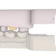 Screenshot_11.png Digital Quadrant Model with 3Shape Articulator Interfaces