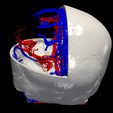 01.jpg 3D Model of Brain Arteriovenous Malformation