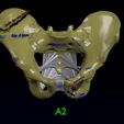 pelvis-fracture-classifications-3d-model-blend-27.jpg Pelvis fracture classifications 3D model