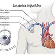 featured_preview_La-chambre-implantable_popin.jpg Implantable exercise chamber