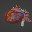 11.png 3D Model of Human Heart with Ventricular Septal Defect (VSD)