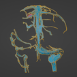 uv17.png 3D Model of Brain Arteriovenous Malformation