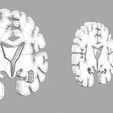 wf3.jpg Alzheimer Disease Brain coronal slice