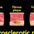 ps0016.jpg Artère Plaque d'athérosclérose et conséquences