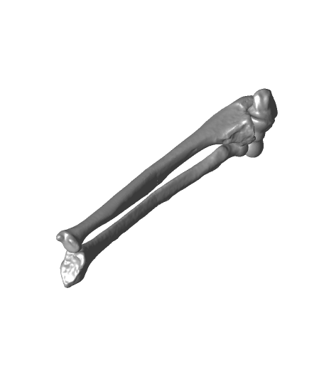 Both_bone_malunion_sag_10_degrees.png Both bone malunion sag 10 degrees.stl