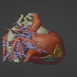 3.png 3D Model of Human Heart with Double Superior Vena Cava (DSVC) - generated from real patient