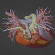 5.png 3D Model of Human Heart with Tetrology of Fallot (TOF) - generated from real patient