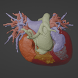 5.png 3D Model of Human Heart with Common Arterial Trunk (CAT) - generated from real patient