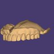 image-20.jpg DIGITAL FLEXIBLE UPPER PARTIAL DENTURE (3D models !!!) - 7 stl files for download)