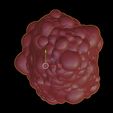 9.jpg 3D Model of Polycystic Kidney