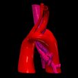 2.jpg 3D Model of Double Aortic Arch