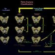 pelvis-fracture-classifications-3d-model-blend.jpg Pelvis fracture classifications 3D model